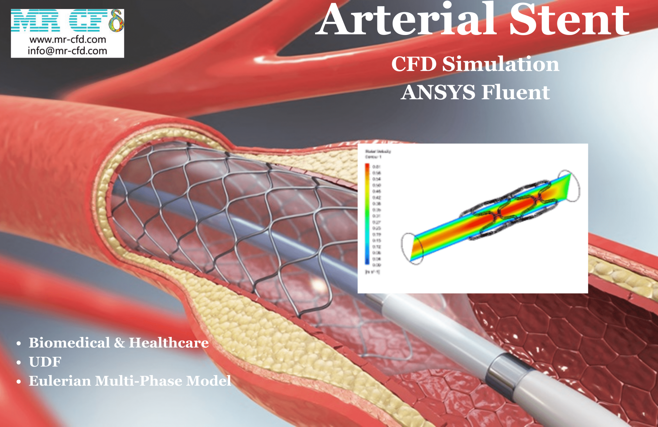 Arterial Stent CFD Simulation, ANSYS Fluent