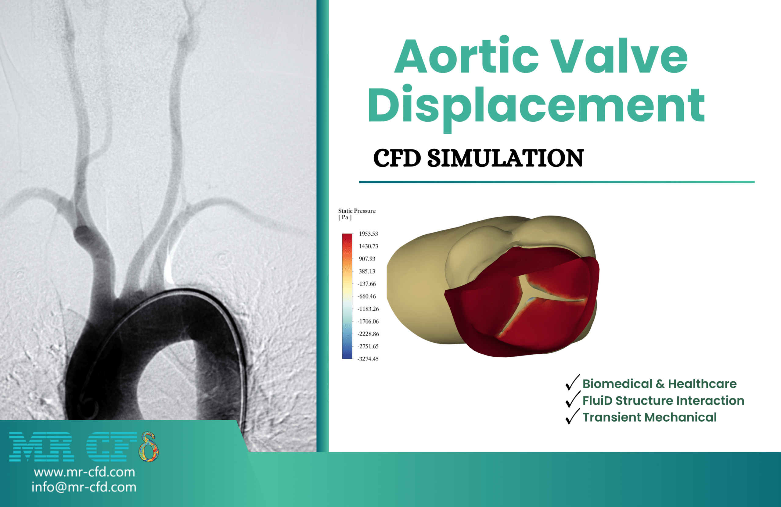 Aortic Valve Displacement CFD Simulation